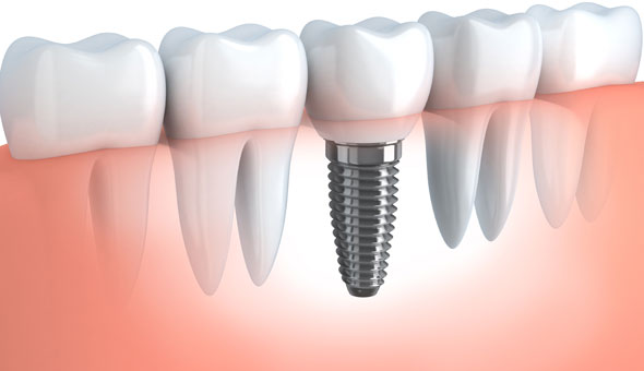 dental-implants-jeff-urban.jpg